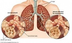 Emphysema