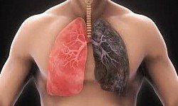 DIFFERENCE IN NORMAL AND AFFECTED LUNG.