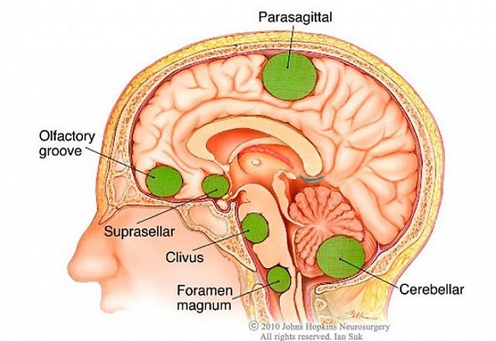 The Most Common Brain Tumors