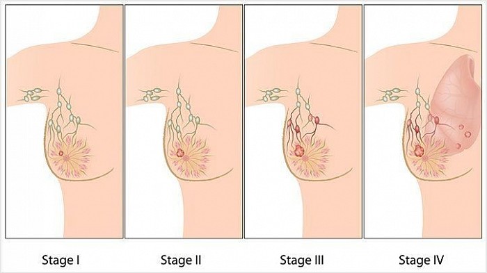 The Stages of Breast Cancer
